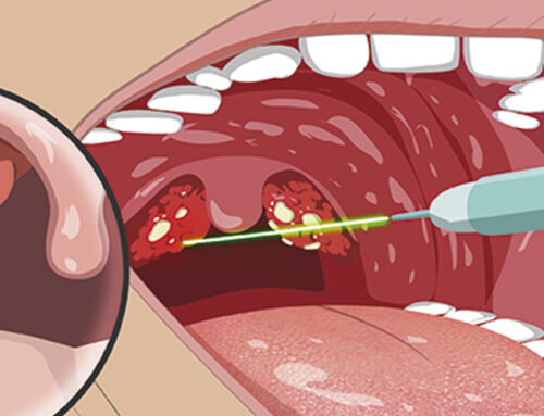 Doctor, ¿qué son esas bolitas blancas que huelen muy mal y salen de mi garganta?
